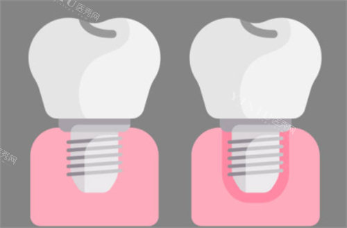 种植牙前后对比图