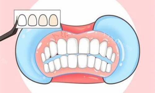 贴面美白示意图