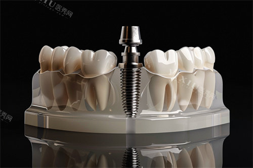 种植牙植体漫画示意图