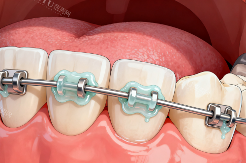 传统牙齿矫正方式展示图
