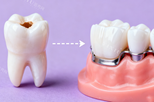 蛀牙问题修复卡通展示图