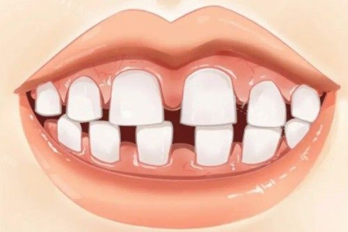 牙齿牙缝大