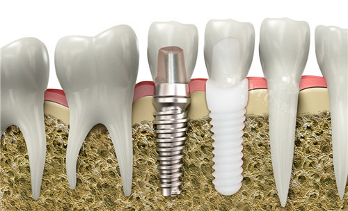 安卓健种植牙修复图