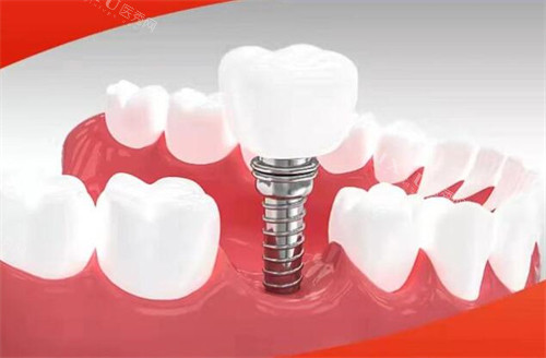 赣州金铂利口腔种植牙