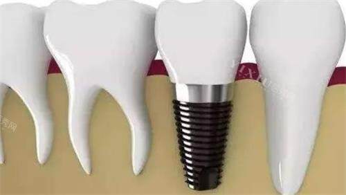 种植牙后***图