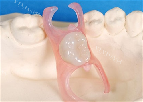 单颗活动假牙展示图