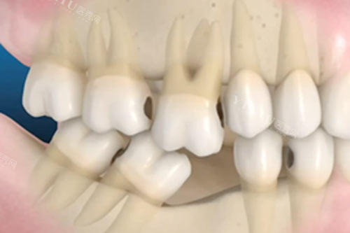牙齿缺一颗不补产生的影响图
