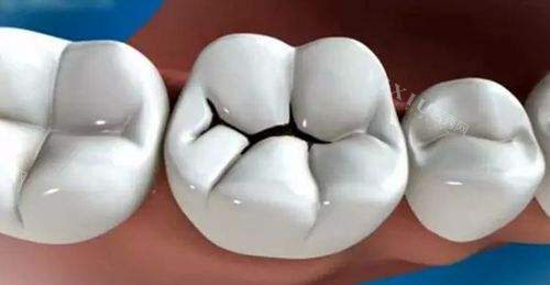 牙齿黑线龋齿漫画图