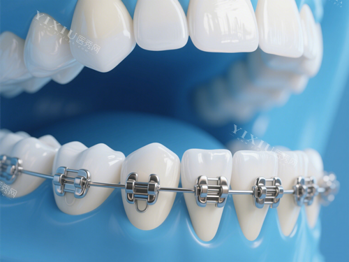 牙齿矫正示意图