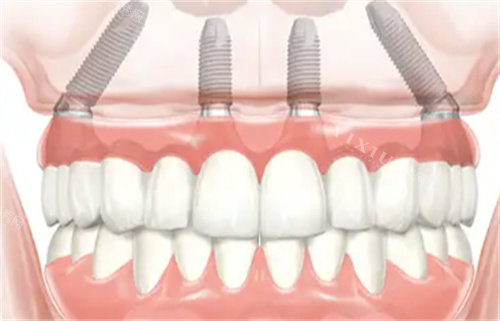 种植牙透视图