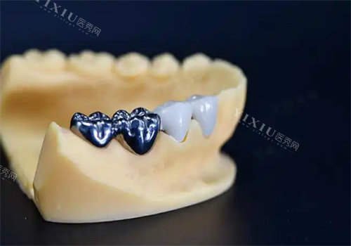 纯钛一体冠牙齿