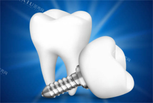 2颗种植牙模型图