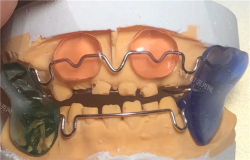 法兰克3矫正器模型实拍