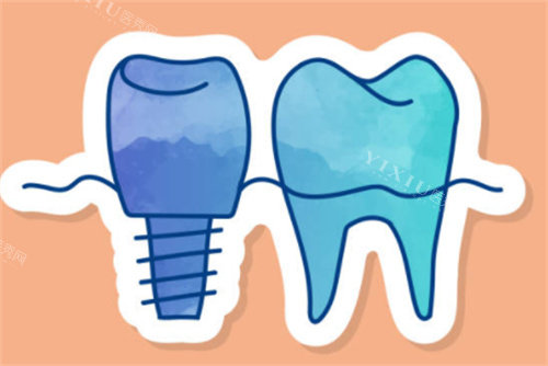 种植牙和正常牙齿
