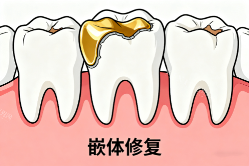 牙齿嵌体修复卡通图