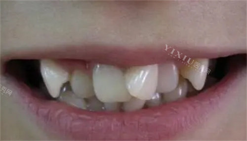 牙齿拥挤的照片