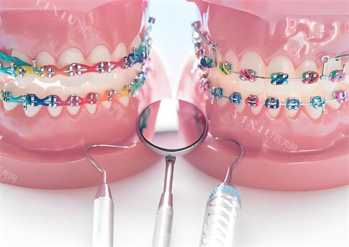 牙齿矫正模型图片