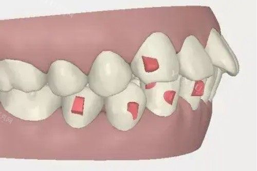 牙齿突出卡通图
