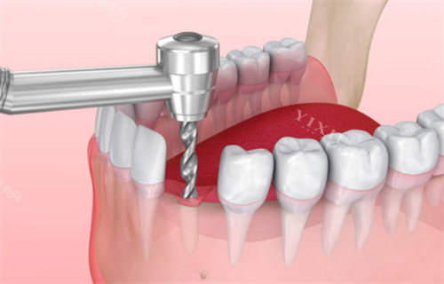 种植牙过程动画展示