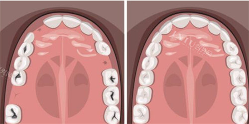 牙齿缺失补牙示意图