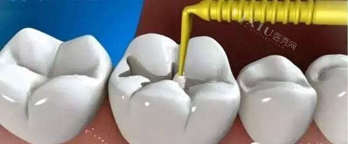 补牙治疗过程示意图