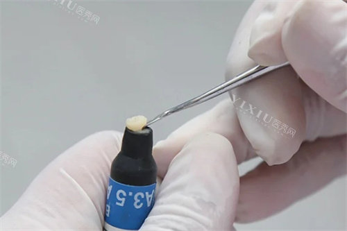 医生取补牙树脂