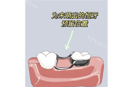 牙齿间隙保持器