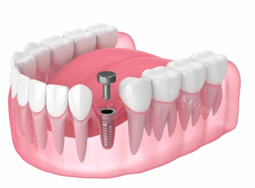 种植牙基台安装透视动画