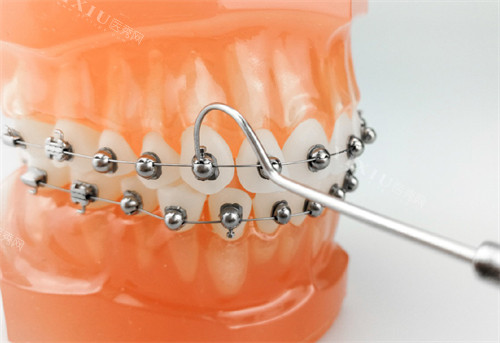 牙齿矫正OBrace球面托槽矫正牙套模型