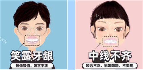 需要矫正的牙齿图解