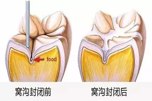 牙齿窝沟封闭前后对比卡通示意图