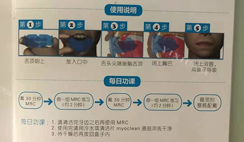 牙齿矫正MRC早期肌功能矫正说明