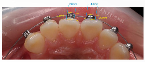 牙齿矫正OBrace球面托槽对比方形托槽大小