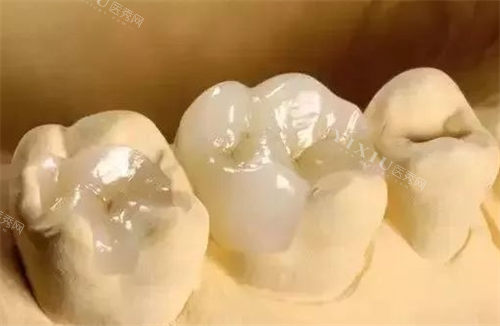 补牙模型展示图