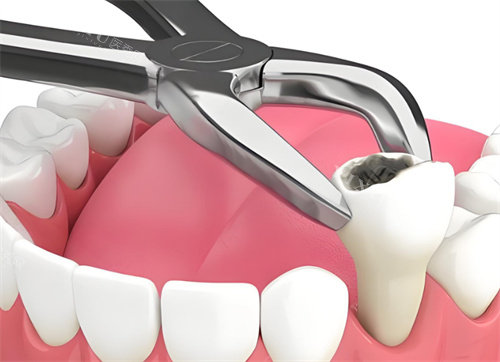 拔牙动画展示图