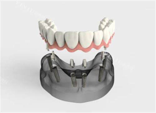 半口种植牙卡通图示意图