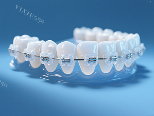 陶瓷托槽牙齿矫正