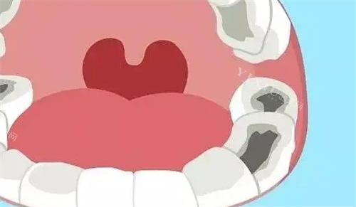 口腔牙齿龋齿动画展示情况