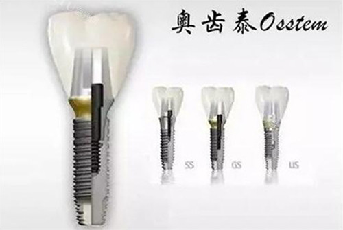奥齿泰种植牙三个系列