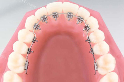 舌侧矫正示意图