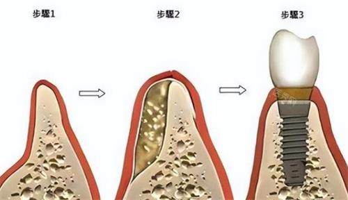 牙科骨粉的使用方法