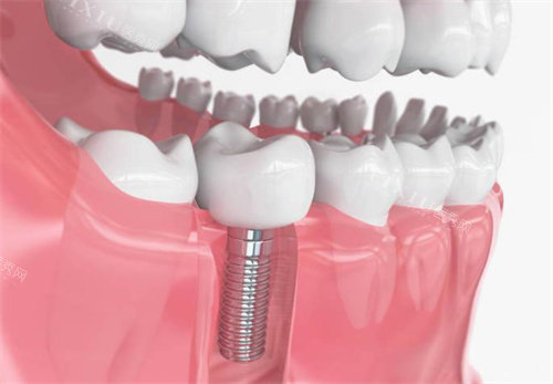 种植牙模型展示图片