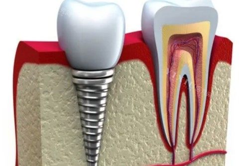 种植牙植入模型图