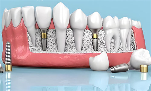 种植牙材料动画展示