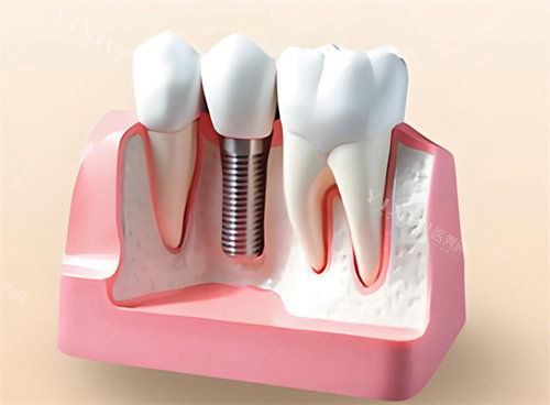 种植牙模型解剖展示