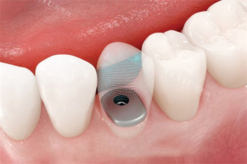 种植牙完成后透视图