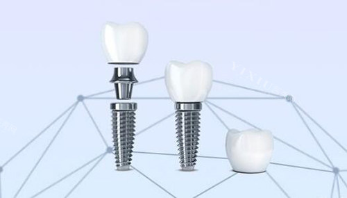 口腔种植牙改善