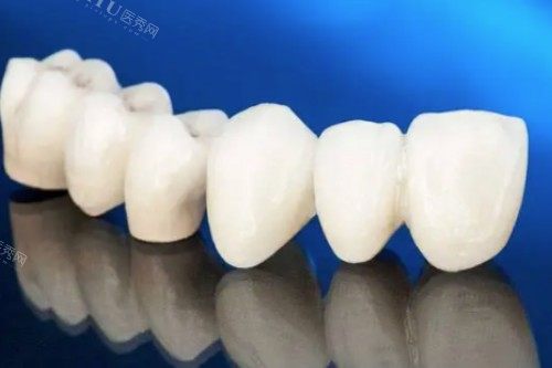 爱尔创全瓷牙模型图