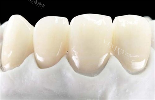 全瓷牙前牙展示