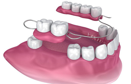可移动部分假牙